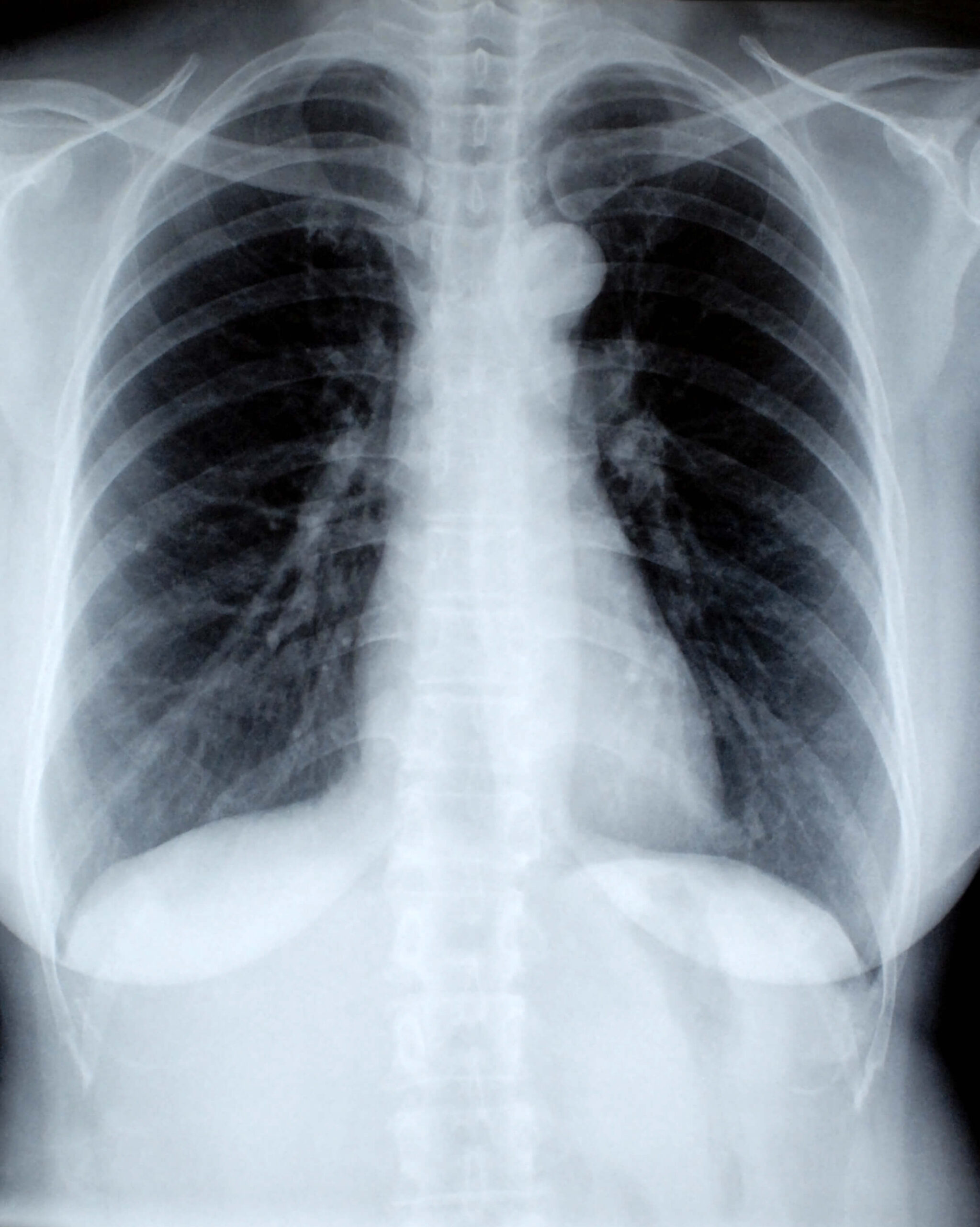 female-chest-x-ray